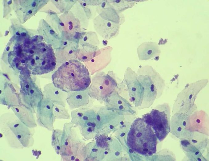 Haemophilus vaginalis
